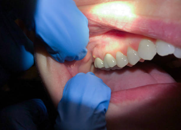 Best Knocked-Out Tooth (Avulsed Tooth) Treatment in Mcclure, PA